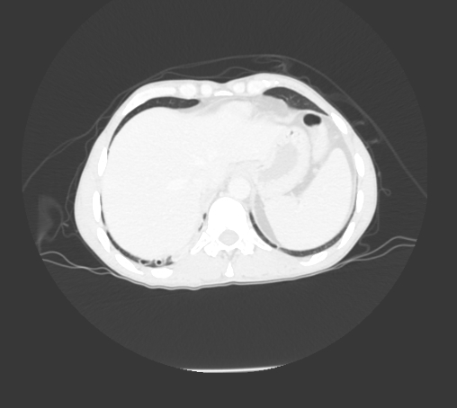 File:Bronchiectasis in Crohn disease (Radiopaedia 60311-67977 Axial lung window 29).jpg