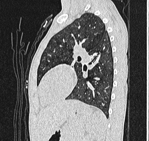Bronchiolitis obliterans (Radiopaedia 71538-81897 Sagittal lung window 46).jpg