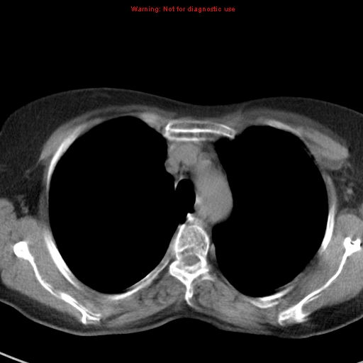 File:Bronchoalveolar carcinoma (BAC) (Radiopaedia 13436-13392 Axial non-contrast 14).jpg