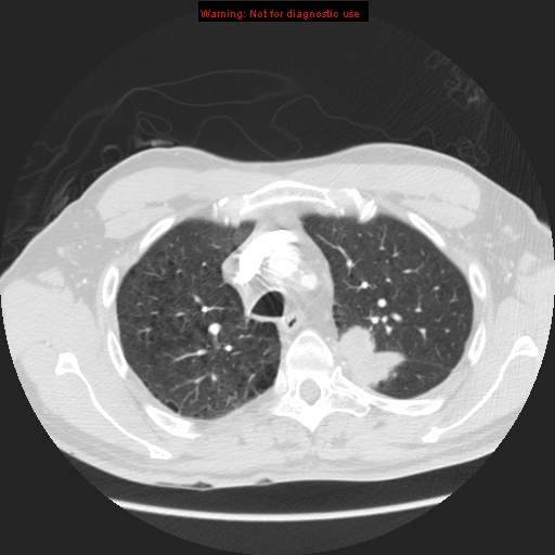 File:Bronchogenic carcinoma brain metastasis (Radiopaedia 9286-105832 Axial lung window 22).jpg
