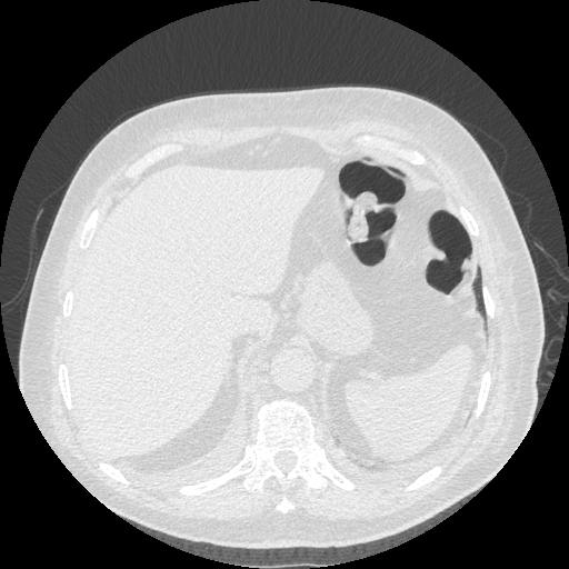 Bronchogenic carcinoma with metastatic lymphadenopathy (Radiopaedia 37671-39569 Axial lung window 50).jpg