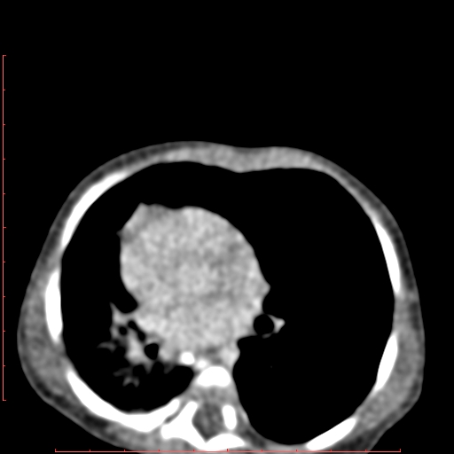 Bronchogenic cyst (Radiopaedia 78599-91409 B 112).jpg
