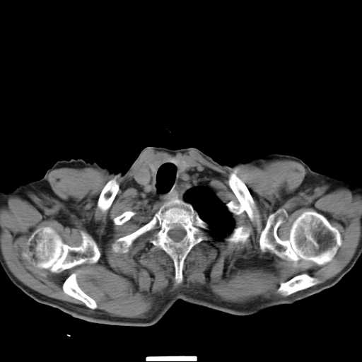 File:Bronchopleural fistula - postoperative complication (Radiopaedia 21020-20947 Axial non-contrast 1).jpg