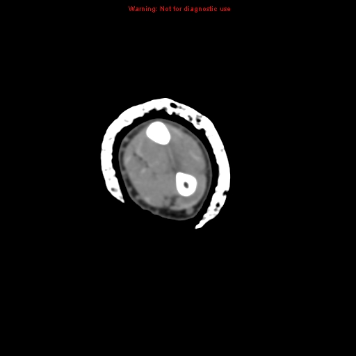 Brown tumor (Radiopaedia 12460-12694 Axial non-contrast 74).jpg