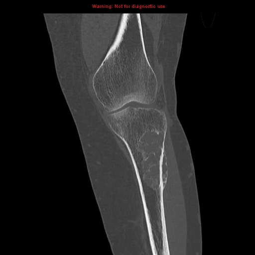 File:Brown tumors (Radiopaedia 9666-10291 Coronal bone window 11).jpg