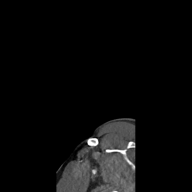 Buccal fat pad arteriovenous malformation (Radiopaedia 70936-81144 C 4).jpg