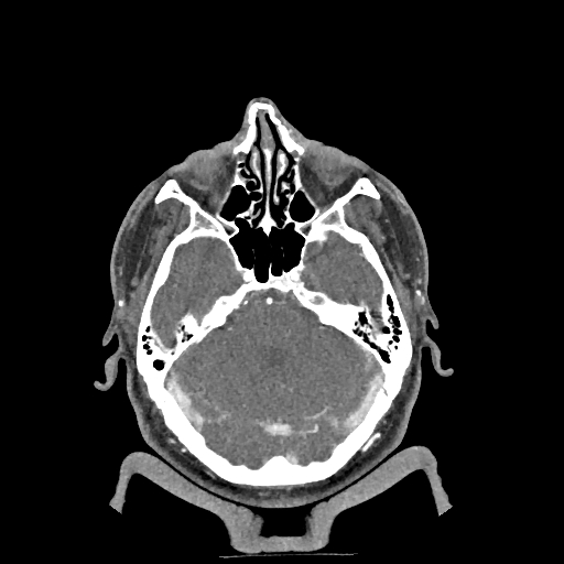 Buccal fat pad arteriovenous malformation (Radiopaedia 70936-81144 D 266).jpg