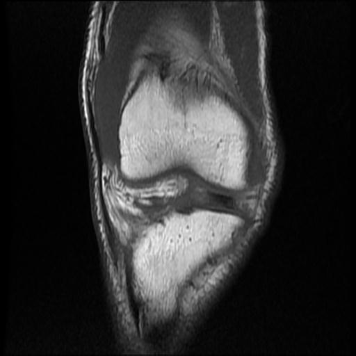File:Bucket handle tear - medial meniscus (Radiopaedia 69245-79026 Coronal T1 6).jpg
