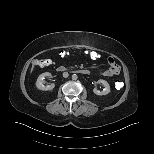 File:Buried bumper syndrome - gastrostomy tube (Radiopaedia 63843-72575 Axial Inject 18).jpg