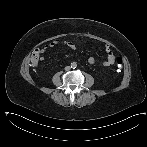 Buried bumper syndrome - gastrostomy tube (Radiopaedia 63843-72577 Axial Inject 68).jpg