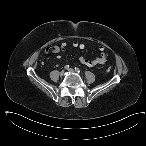 File:Buried bumper syndrome - gastrostomy tube (Radiopaedia 63843-72577 Axial Inject 82).jpg