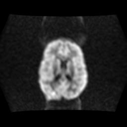 File:Burkitt lymphoma of the orbit- pre and post chemotherapy (Radiopaedia 31214-31929 Axial DWI 10).jpg