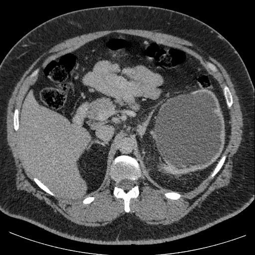 Burned-out testicular seminoma - retroperitoneal nodal metastases (Radiopaedia 62872-71245 A 23).jpg