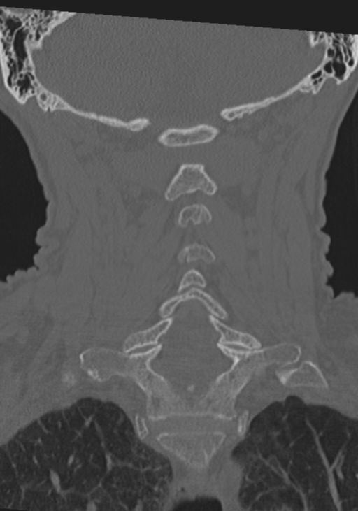 C2 fracture with vertebral artery dissection (Radiopaedia 37378-39199 Coronal bone window 32).png