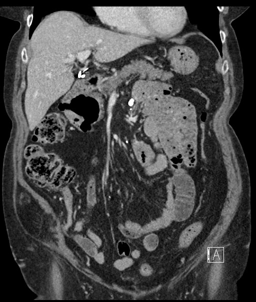 Calcified adrenal glands and Spigelian hernia (Radiopaedia 49741-54988 B 40).jpg