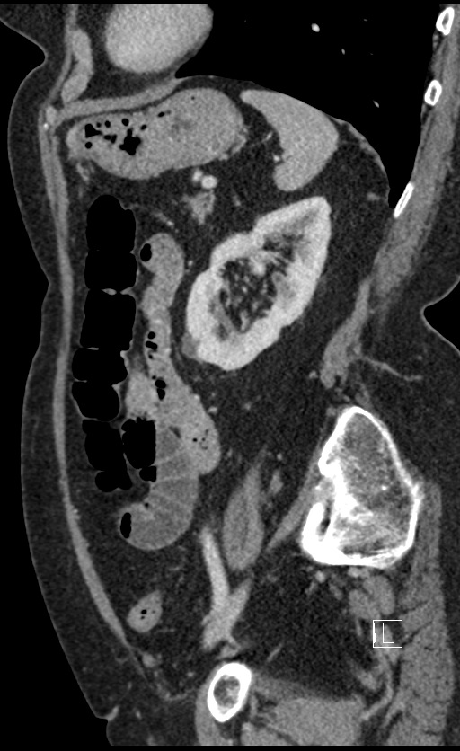 Calcified adrenal glands and Spigelian hernia (Radiopaedia 49741-54988 C 47).jpg