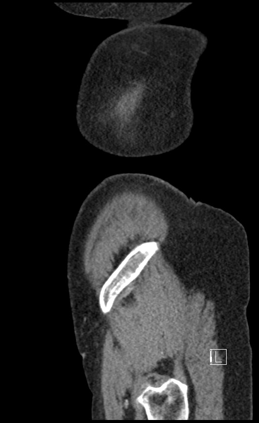 Calcified adrenal glands and Spigelian hernia (Radiopaedia 49741-54988 C 9).jpg