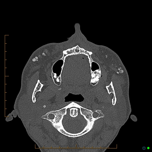 Calcified facial augmentation fillers (Radiopaedia 79514-92679 Axial bone window 73).jpg