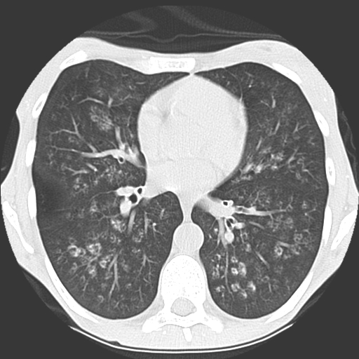 File:Calciphylaxis and metastatic pulmonary calcification (Radiopaedia 10887-11317 Axial lung window 25).jpg