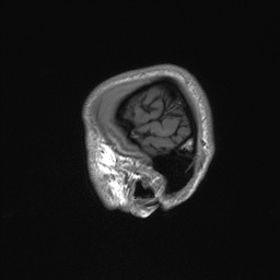 File:Callosal dysgenesis with interhemispheric cyst (Radiopaedia 53355-59335 Sagittal T1 16).jpg