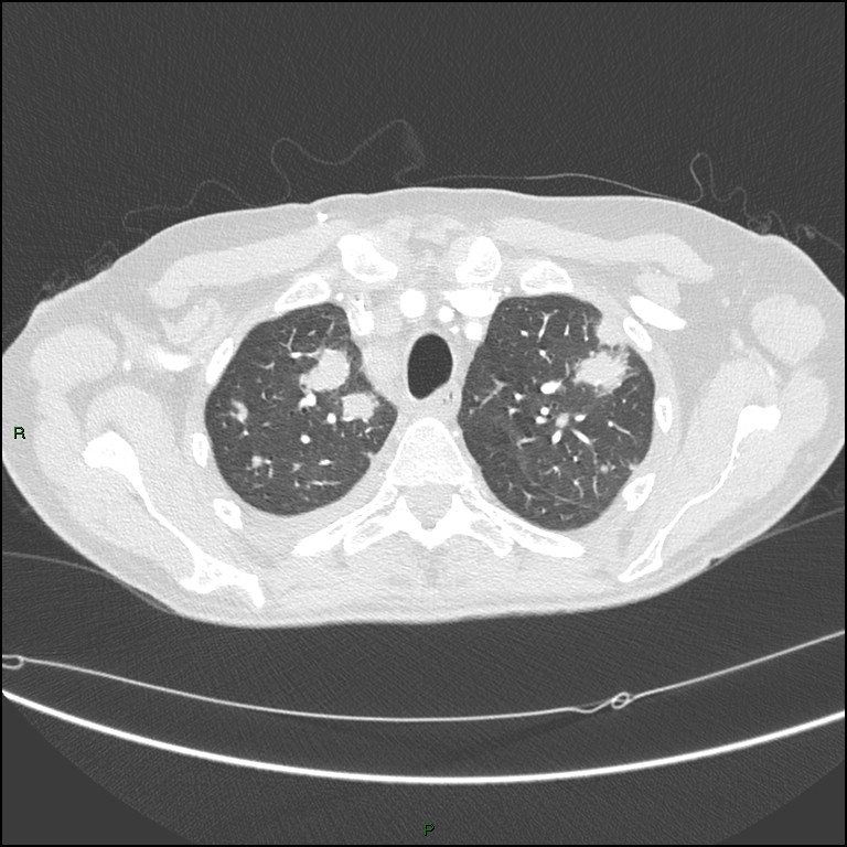 Cannonball metastases (Radiopaedia 82110-96150 Axial lung window 49).jpg