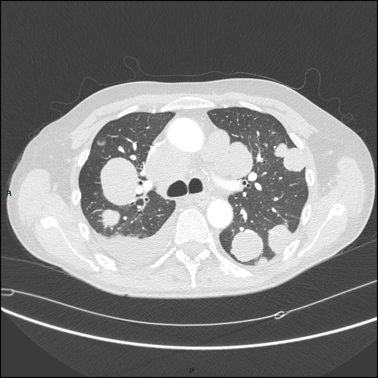 Cannonball metastases (Radiopaedia 82110-96150 Axial lung window 77).jpg