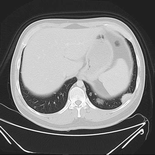 File:Cannonball pulmonary metastases (Radiopaedia 67684-77101 Axial lung window 23).jpg