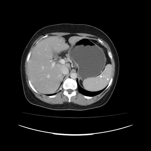 File:Carcinoma colon - hepatic flexure (Radiopaedia 19461-19493 A 33).jpg