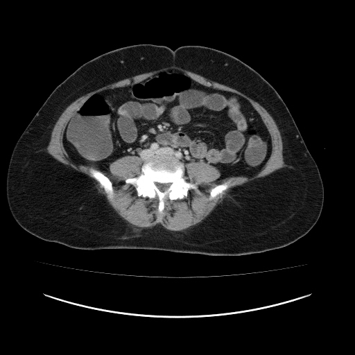 File:Carcinoma colon - hepatic flexure (Radiopaedia 19461-19493 A 81).jpg