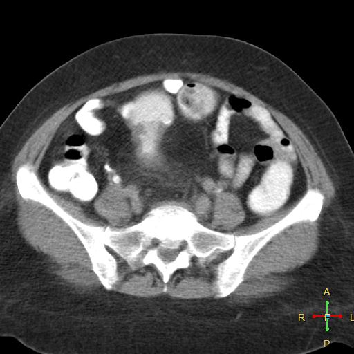 File:Carcinoma of sigmoid colon (Radiopaedia 23071-23100 C+ delayed 18).jpg