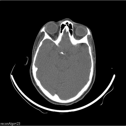 File:Carcinoma of the maxillary antrum (Radiopaedia 53805-59888 Axial non-contrast 76).jpg