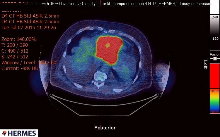 File:Cardiac lymphoma (Radiopaedia 38690-40871 Integrated PET-CT 18).jpg