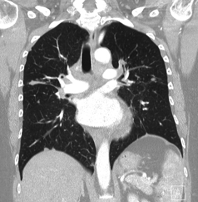 Cardiac sarcoidosis (Radiopaedia 74548-85534 Coronal lung window 37).jpg