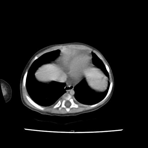 Caroli disease with autosomal recessive polycystic kidney disease (ARPKD) (Radiopaedia 89651-106703 B 12).jpg