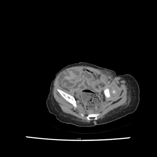 Caroli disease with autosomal recessive polycystic kidney disease (ARPKD) (Radiopaedia 89651-106703 B 201).jpg