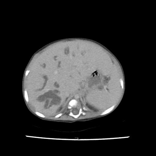 Caroli disease with autosomal recessive polycystic kidney disease (ARPKD) (Radiopaedia 89651-106703 B 47).jpg