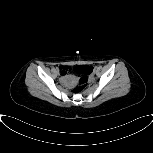 File:Caroli disease with medullary sponge kidney (Radiopaedia 82622-96804 Axial non-contrast 64).jpg