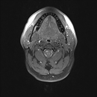 File:Carotid artery dissection (Radiopaedia 28441-28689 Axial T1 fat sat 27).jpg