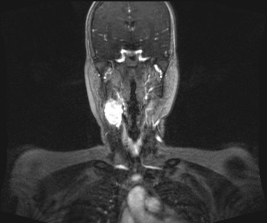 Carotid body tumor (Radiopaedia 12777-12912 MRA 26).jpg