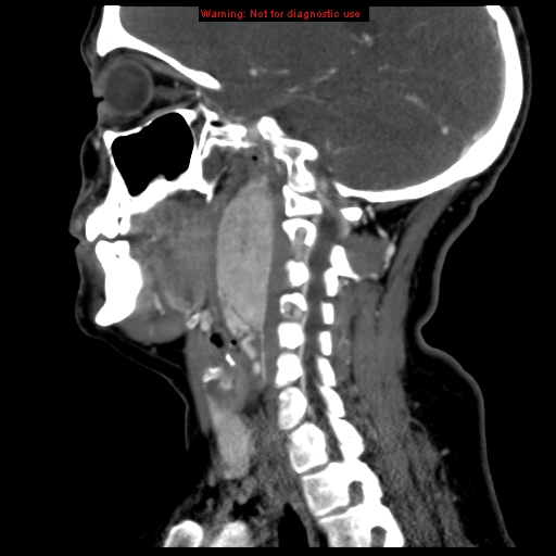 Carotid body tumor with lung metastases (Radiopaedia 9301-9986 Sagittal C+ delayed 31).jpg