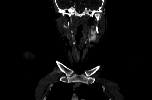 File:Carotid bulb pseudoaneurysm (Radiopaedia 57670-64616 D 8).jpg