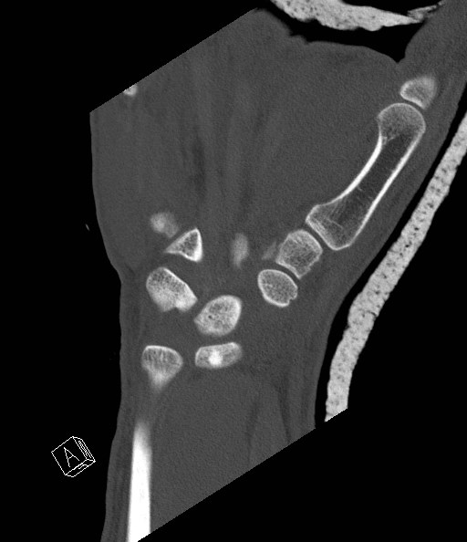 File:Carpal fractures (smart watch impaction) (Radiopaedia 55844-62430 Coronal bone window 17).jpg