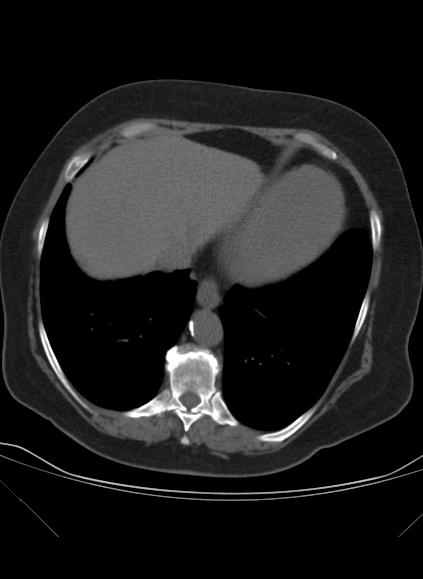 File:Caseous mitral annular calcification (Radiopaedia 61219-69122 Axial non-contrast 20).jpg