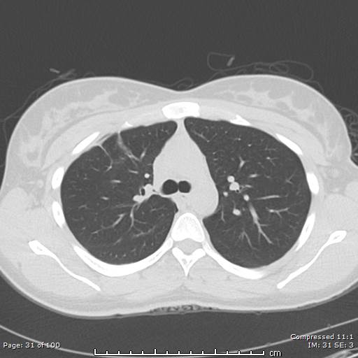 Catamenial pneumothorax (Radiopaedia 54382-60600 Axial non-contrast 31).jpg