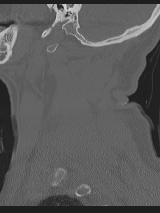 Cavernoma of cervical cord (Radiopaedia 50838-56346 Sagittal bone window 13).png