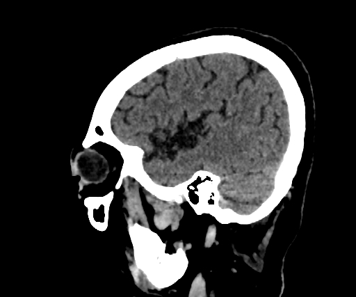 Cavernous hemangioma of the cerebellar falx (Radiopaedia 73025-83723 B 256).jpg