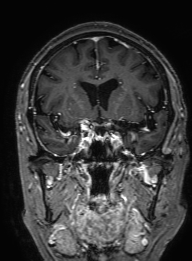 Cavernous hemangioma of the cerebellar falx (Radiopaedia 73025-83724 Coronal T1 C+ 149).jpg