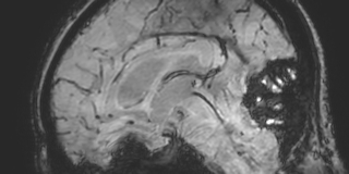 Cavernous hemangioma of the cerebellar falx (Radiopaedia 73025-83724 Sagittal BOLD 102).jpg