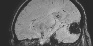 Cavernous hemangioma of the cerebellar falx (Radiopaedia 73025-83724 Sagittal BOLD 69).jpg