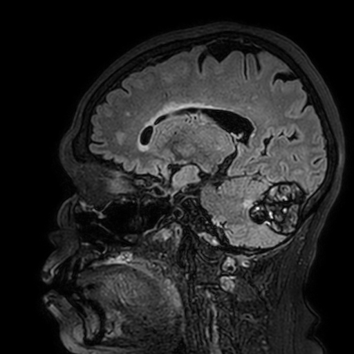 Cavernous hemangioma of the cerebellar falx (Radiopaedia 73025-83724 Sagittal FLAIR 135).jpg